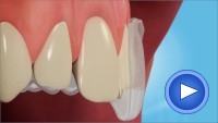 Teeth Whitening Medivision Video