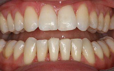 Six Month Smiles After
