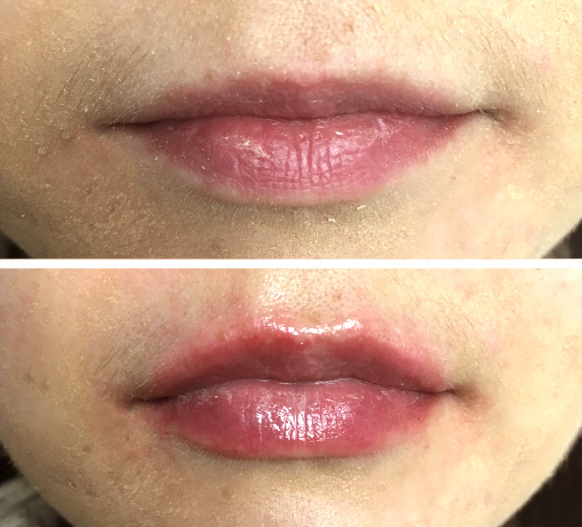 Lip fillers near me treatment at Marchmont Dental in Edinburgh