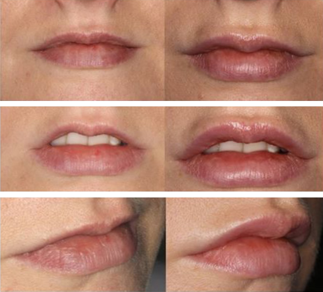 Lip fillers near me at Marchmont Dental in Edinburgh