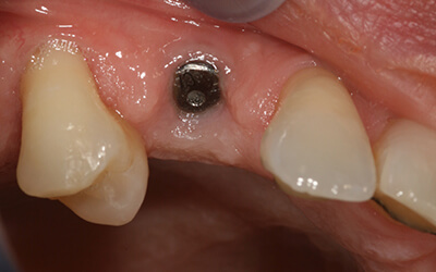 Dental Implants near me case study before in Edinburgh