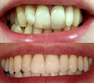 Invisalign before and after Edinburgh