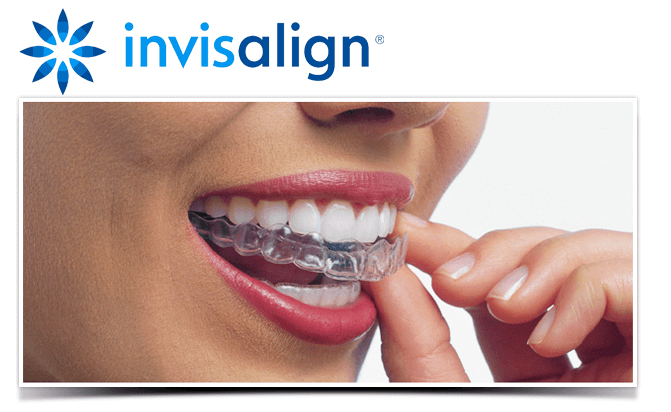 Invisalign in Scotland Edinburgh