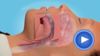 Snoring Medivision Video