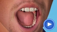 White fillings Medivision Video