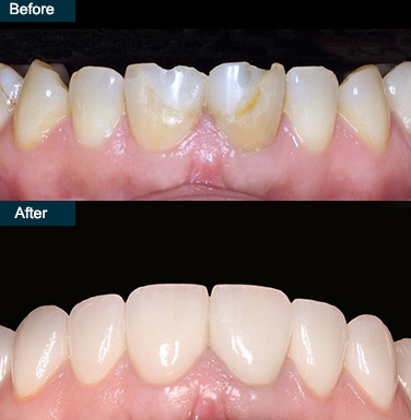 Porcelain dental veneers Edinburgh Scotland