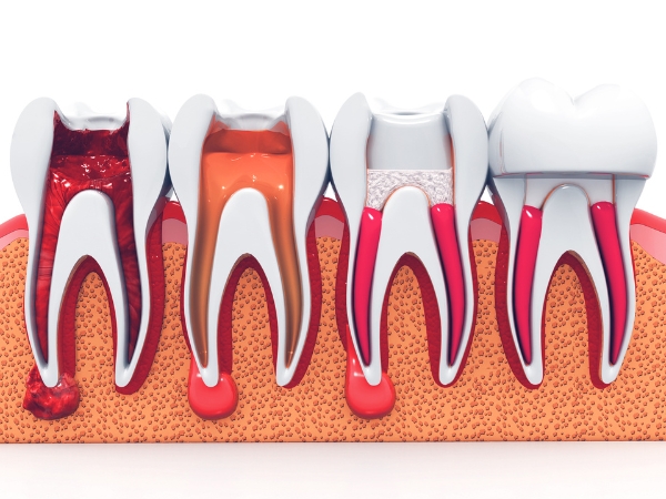 root canal treatment Edinburgh