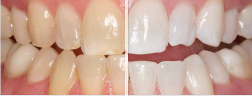 low cost teeth whitening in edinburgh scotland