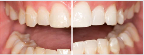 teeth whitening in edinburgh before and after