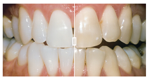 Teeth whitening Edinburgh